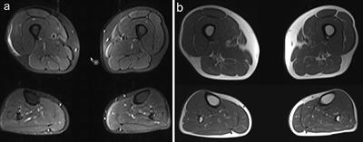 <mark class="highlighted">Colchicine</mark> Myopathy: A Case Series Including Muscle MRI and ABCB1 Polymorphism Data